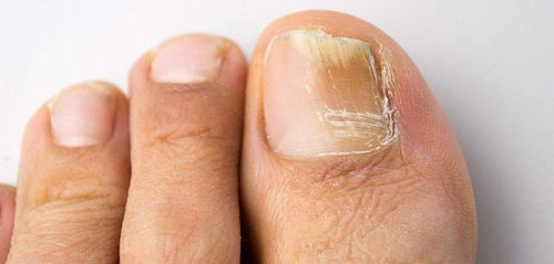 Fungal Nail Infections: What you need to know-Scholl UK