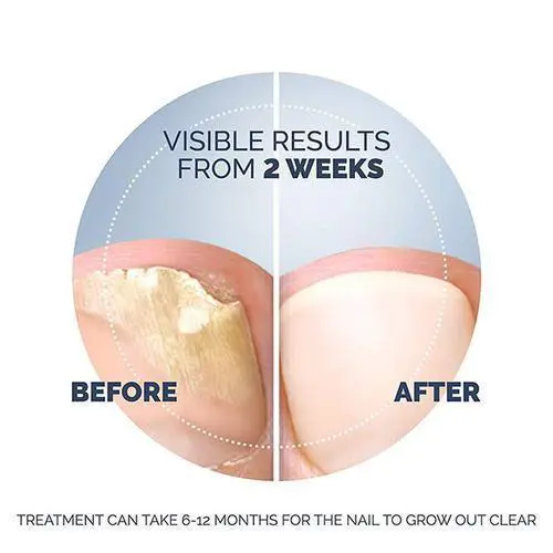 aid-fungal-nail-treatment-kit-37240010604713-1 - Dr. Scholl's™ UK